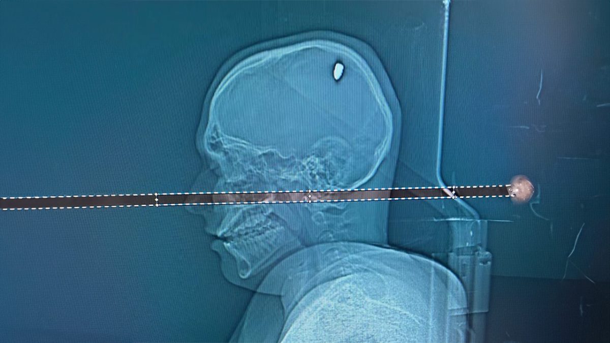 Homem passou dias festejando antes de perceber que havia levado um tiro na cabeça