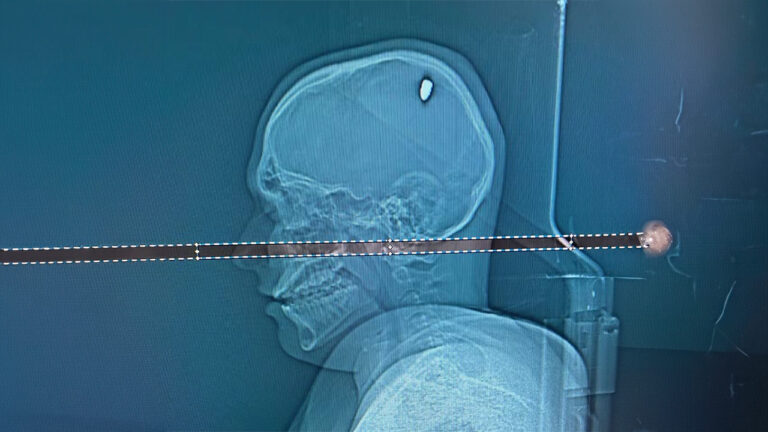 Homem passou dias festejando antes de perceber que havia levado um tiro na cabeça