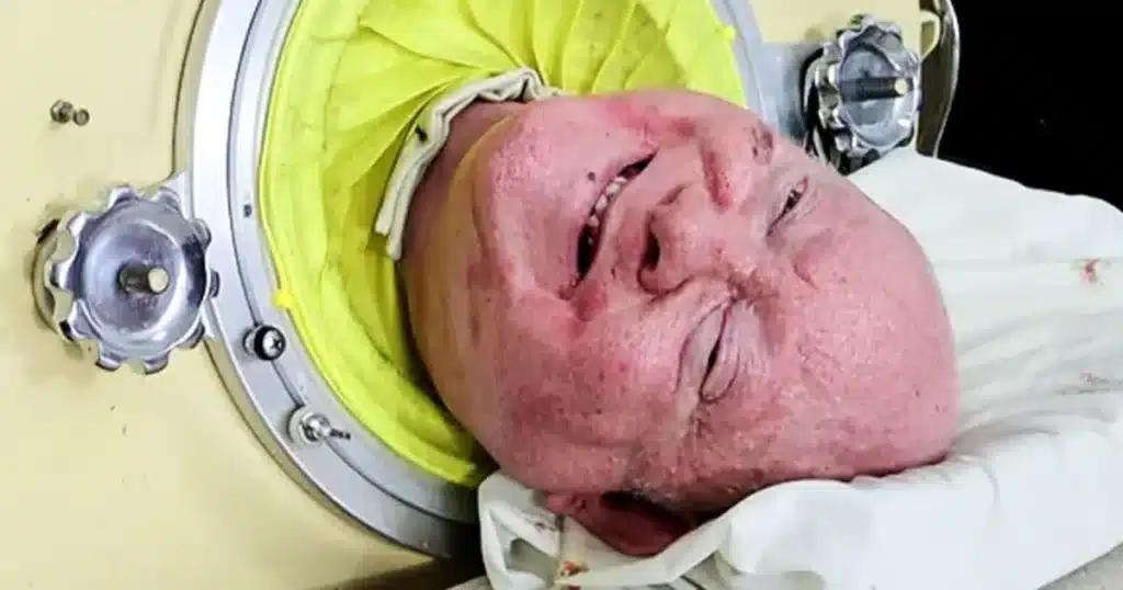 Homem que viveu dentro de um pulmão de ferro por mais de 70 anos morre aos 78 anos