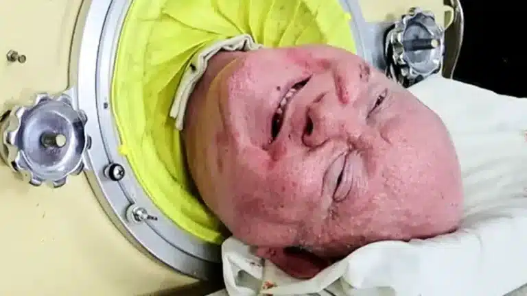 Homem que viveu dentro de um pulmão de ferro por mais de 70 anos morre aos 78 anos