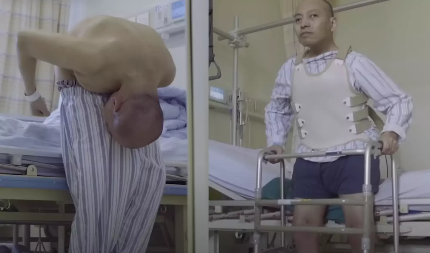 'Homem dobrado' que passou 28 anos curvado finalmente faz cirurgia