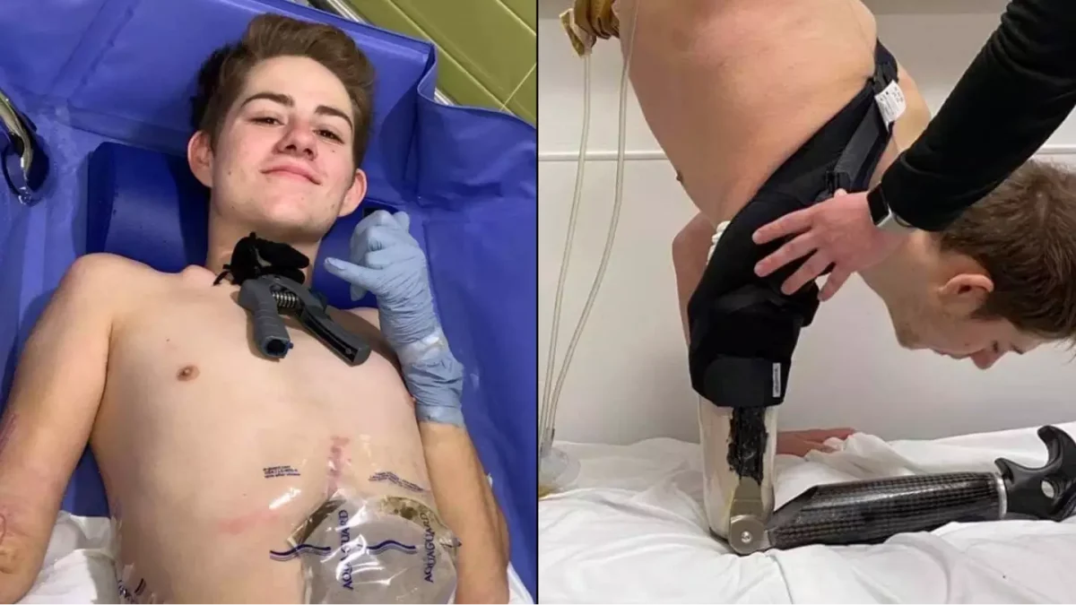 Jovem cortado ao meio por empilhadeira faz confissão comovente sobre sua vida desde o acidente devastador
