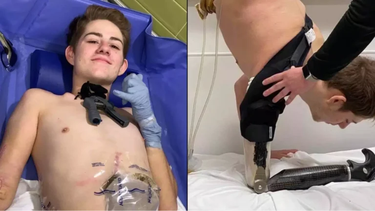Jovem cortado ao meio por empilhadeira faz confissão comovente sobre sua vida desde o acidente devastador