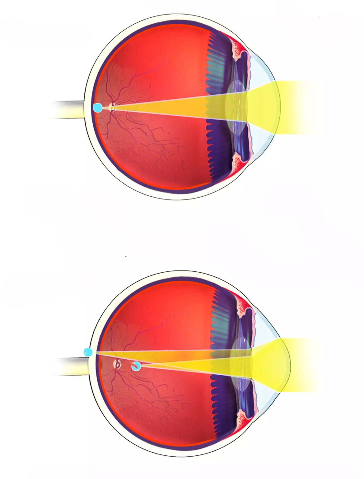 O astigmatismo (mostrado na parte inferior) deixa as pessoas com olhos de formatos diferentes. (Wikimedia Commons)