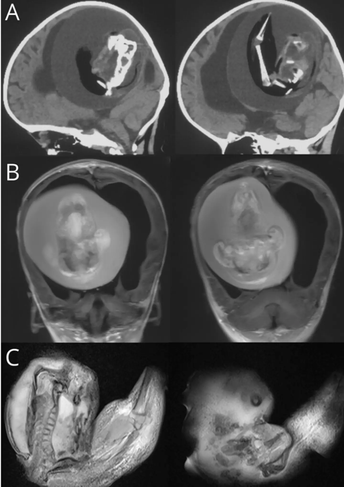 A tomografia computadorizada da cabeça da criança de um ano (Neurology Journals/ Zongze Li et al)