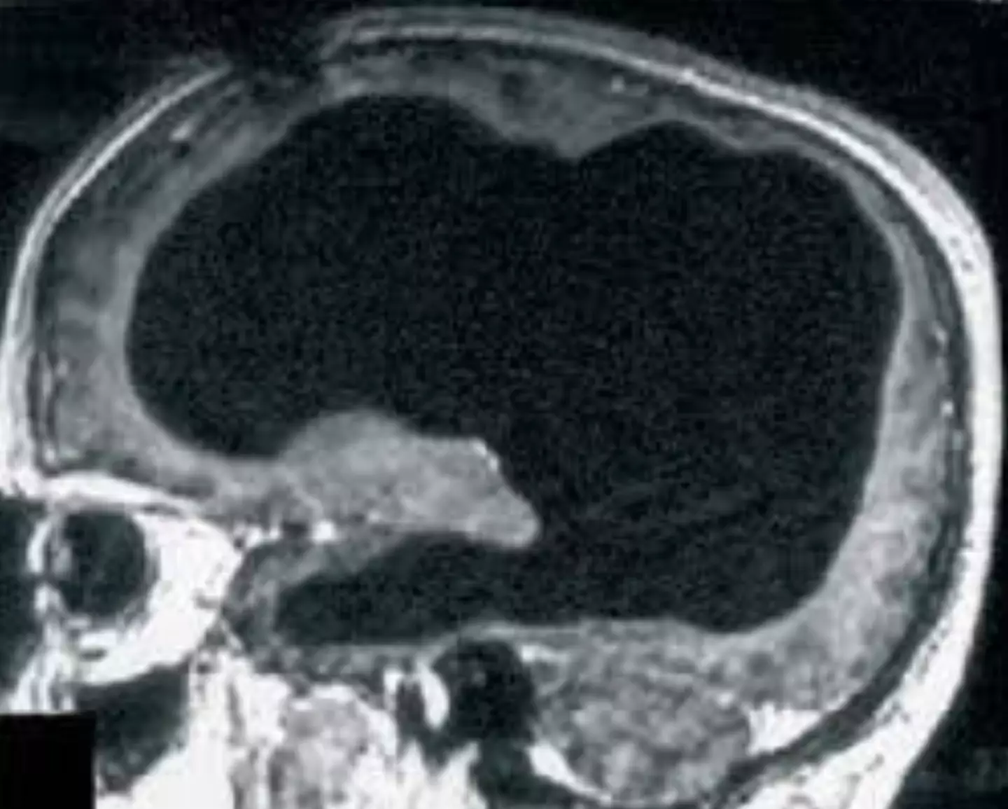 A imagem deveria mostrar o cérebro do homem... exceto que a maior parte dele está ausente. (Feuillet et al./The Lancet)