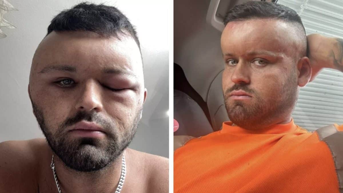 Homem ficou parecendo 'Megamente' depois de ter uma reação tão forte que sua namorada 'não conseguia olhar para ele'