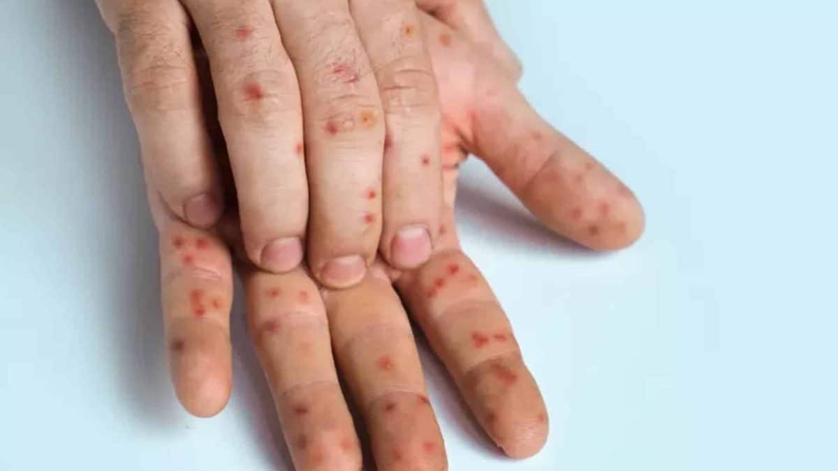Mpox