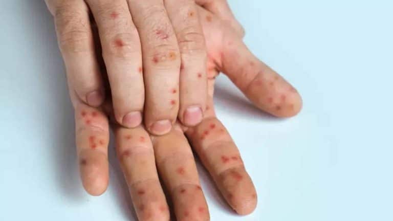 Mpox