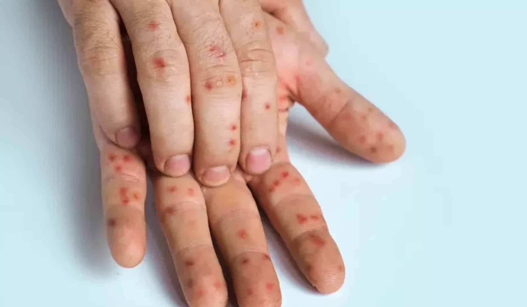 Pessoas são alertadas sobre o primeiro sintoma de mpox que pode ser confundido com algo inofensivo Mpox