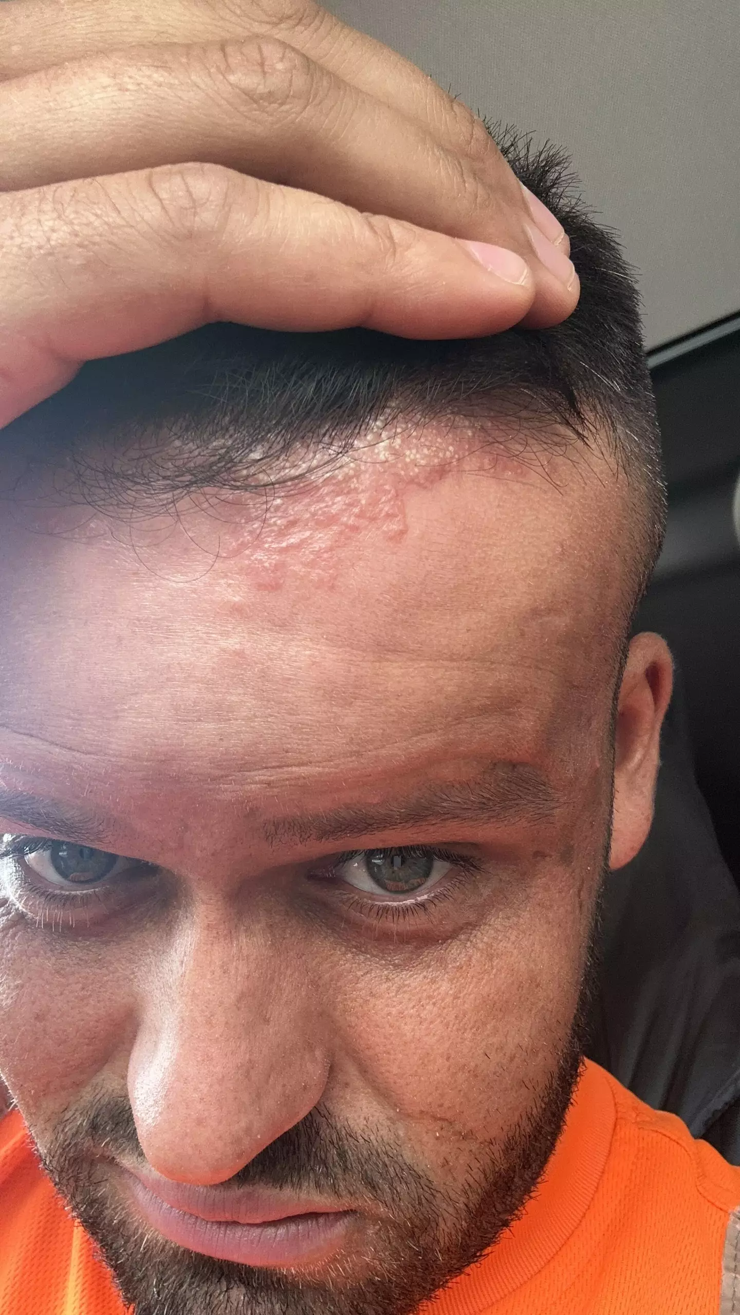 Ryan Briggs notou uma erupção ao longo da linha do cabelo (Kennedy News and Media).