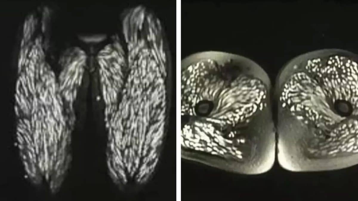 Scans horripilantes mostram o corpo de uma mulher infestado por parasitas, que vinha consumindo carne de porco crua há 10 anos