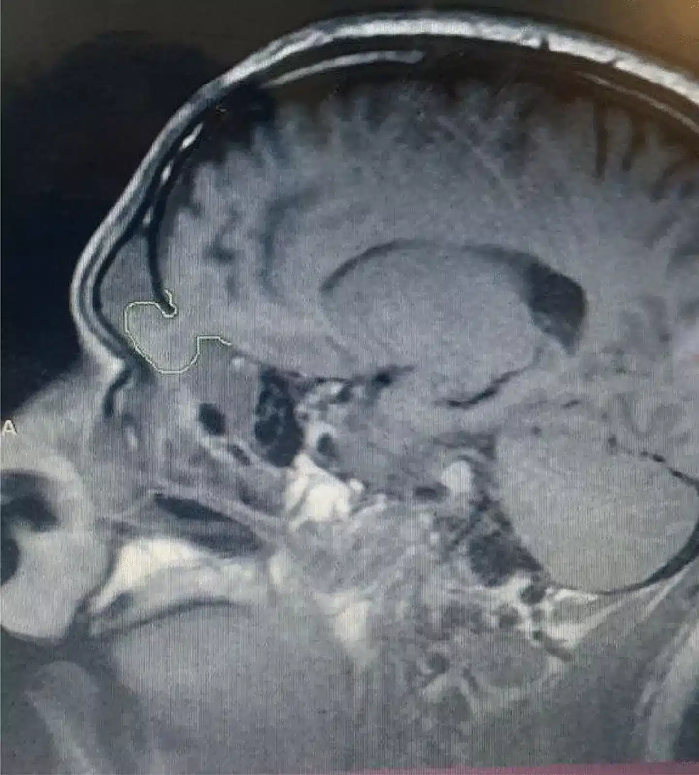 A condição desenvolveu-se após um trauma craniano (Kenana Tawashi et al.).