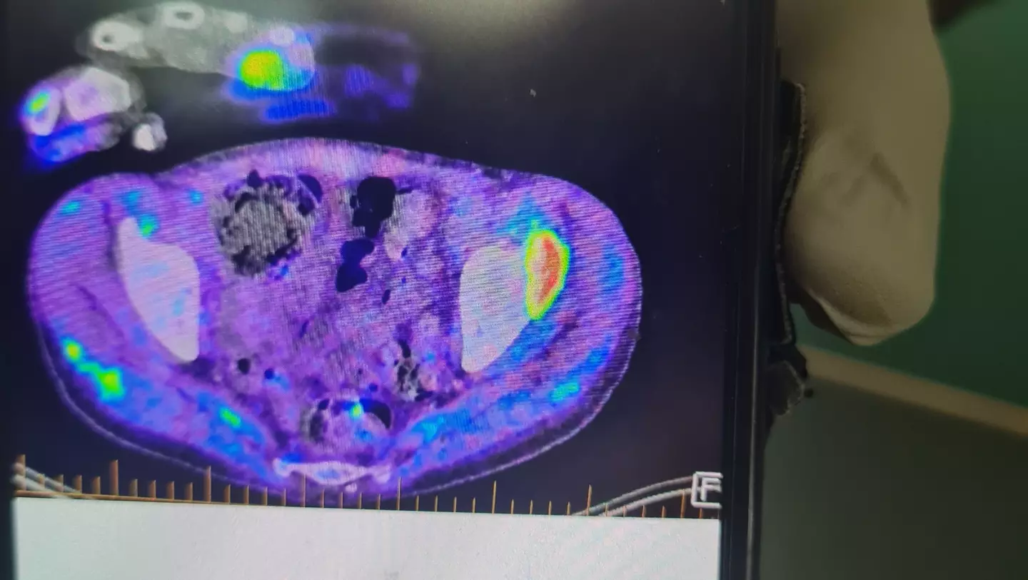 Chris está com uma doença causada por micobactérias não tuberculosas (NTM).