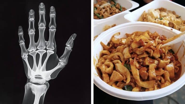 Estudante perdeu todos os membros após comer restos de comida do colega de quarto