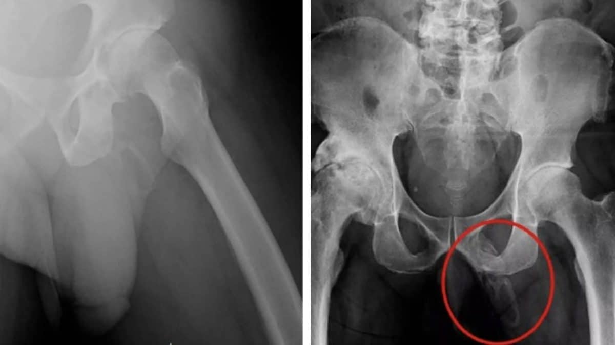 Médicos descobrem que pênis de homem está se transformando em osso devido a uma 'condição rara'
