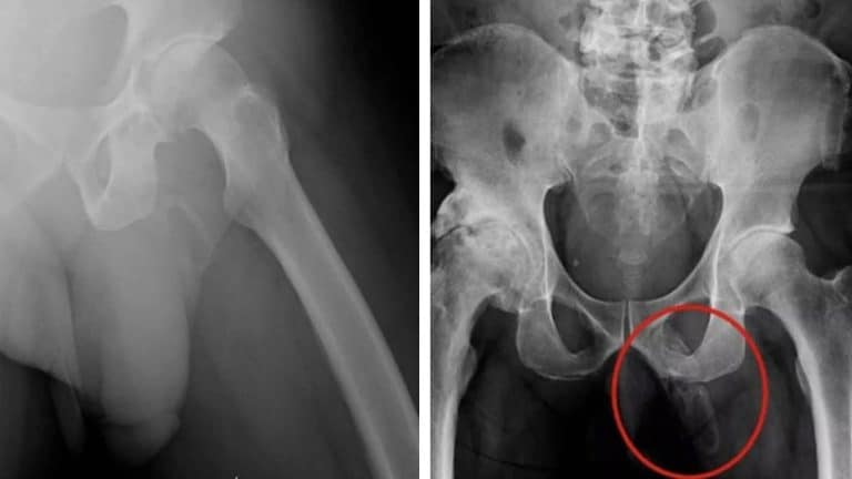 Médicos descobrem que pênis de homem está se transformando em osso devido a uma 'condição rara'