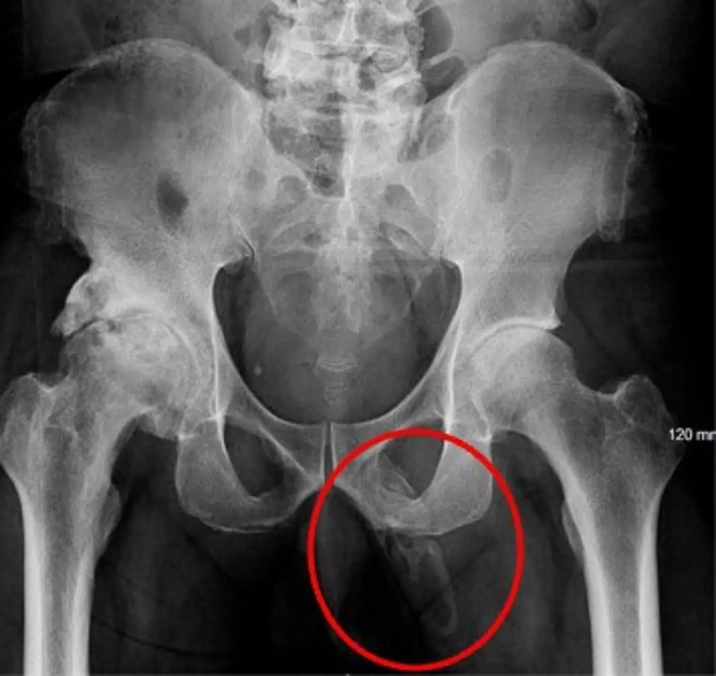 Os médicos encontraram evidências de calcificação no pênis do homem (Urology Case Reports).