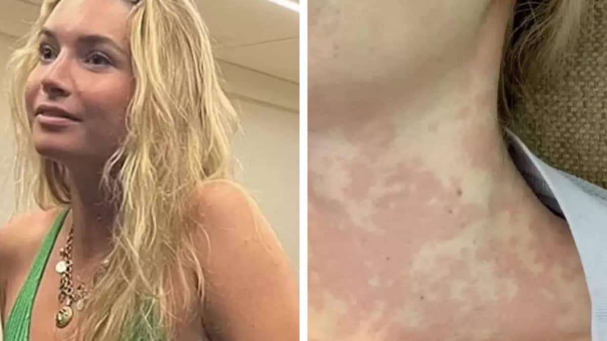 Mulher sofre de condição rara que faz com que beijar alguém nos lábios possa matá-la