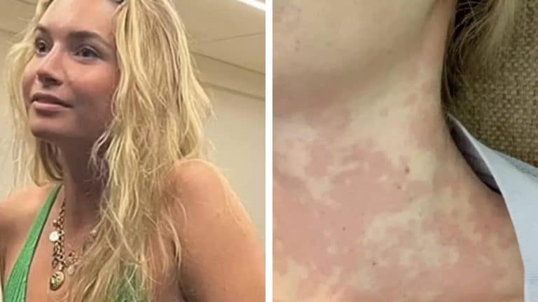 Mulher sofre de condição rara que faz com que beijar alguém nos lábios possa matá-la