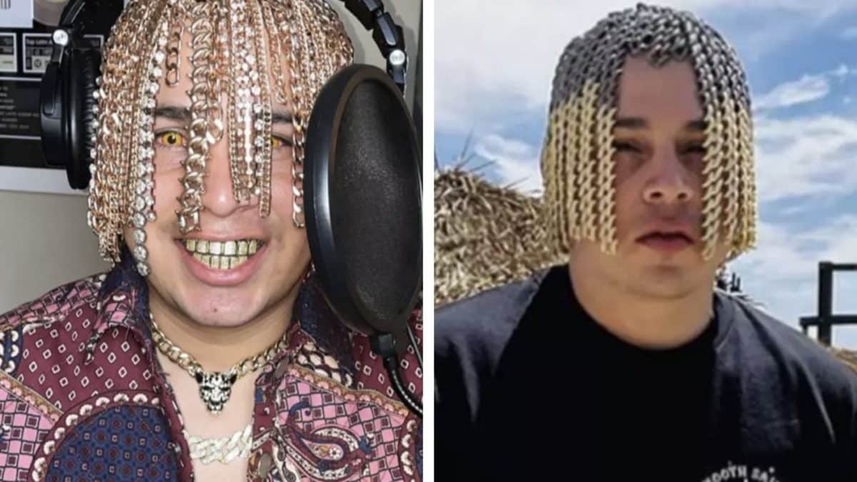 Rapper enfrenta riscos graves após implantar correntes de ouro na cabeça para parecer cabelo