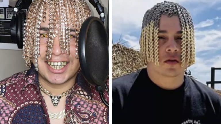 Rapper enfrenta riscos graves após implantar correntes de ouro na cabeça para parecer cabelo