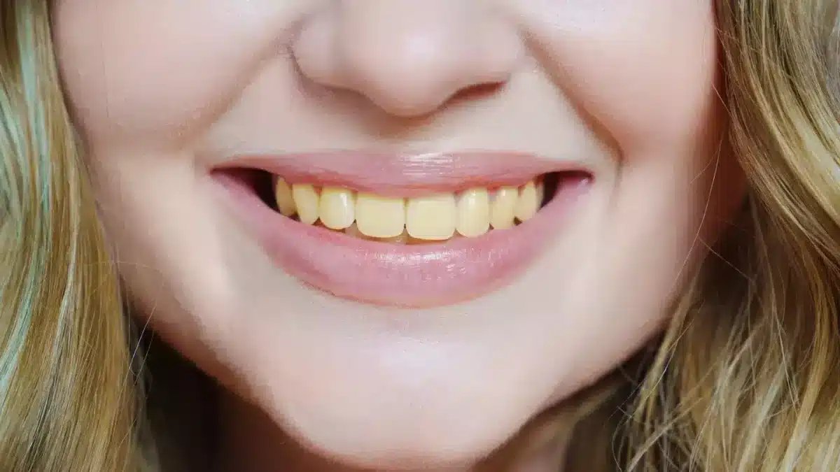 Dentista alerta sobre erro comum que deixa dentes amarelados