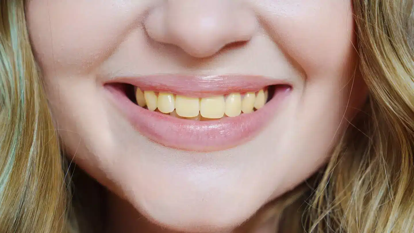 Dentista alerta sobre erro comum que deixa dentes amarelados