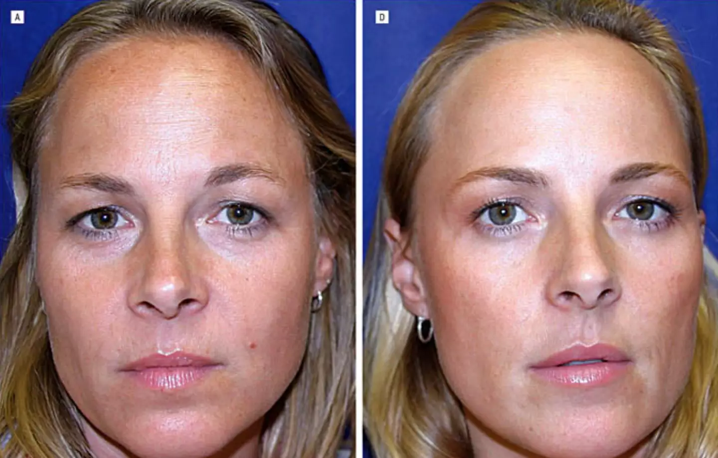 A Gêmea 1 (à esquerda) apresentava rugas mais perceptíveis após 13 anos com uso mínimo de Botox (Sociedade Americana de Cirurgia Dermatológica).