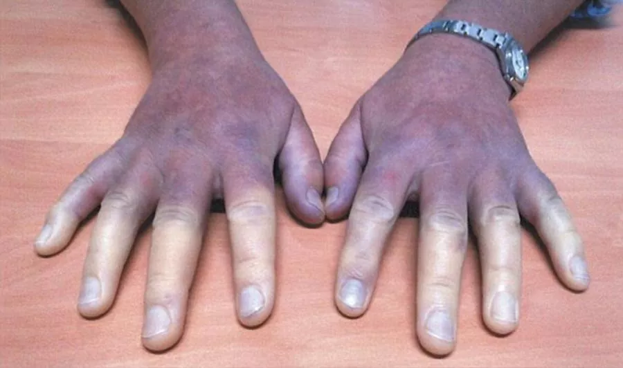 A doença de Raynaud é agravada por climas muito frios