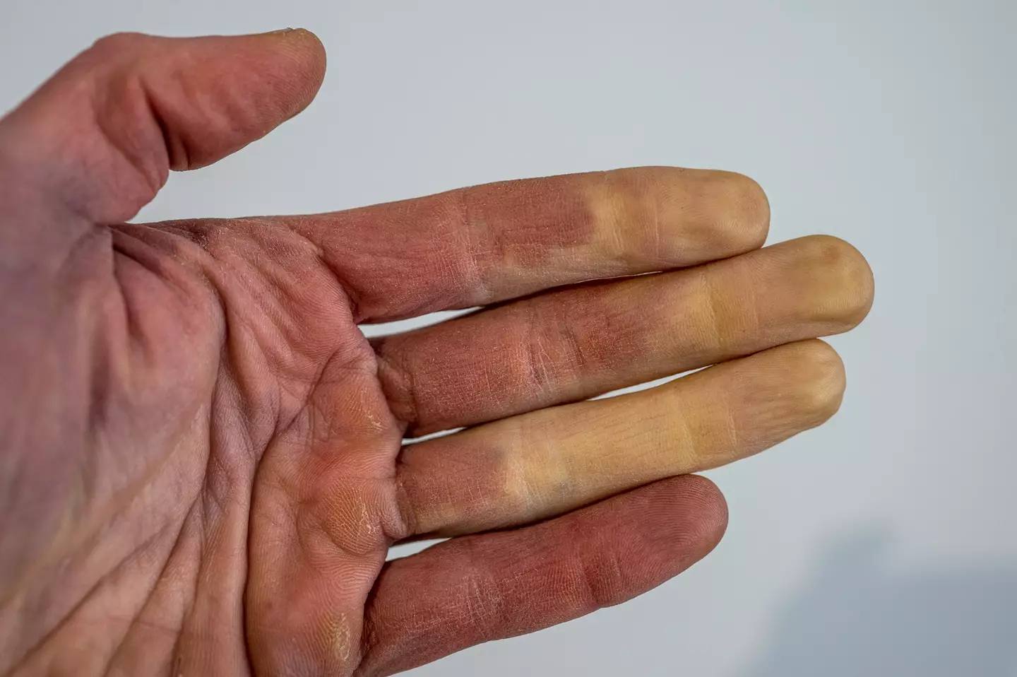 Dedos brancos pálidos são um sintoma comum da doença de Raynaud