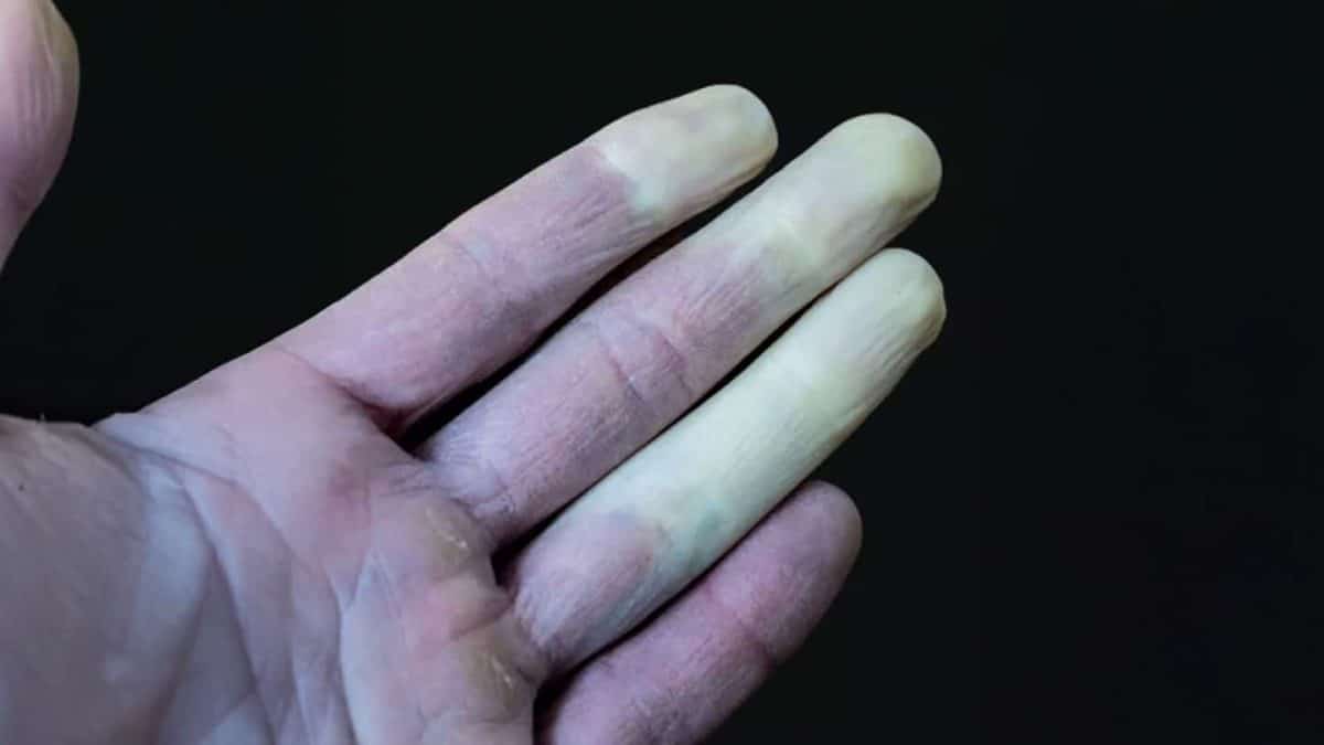 Doença comum pode ser a razão para seus dedos mudarem de cor nos meses frios do inverno