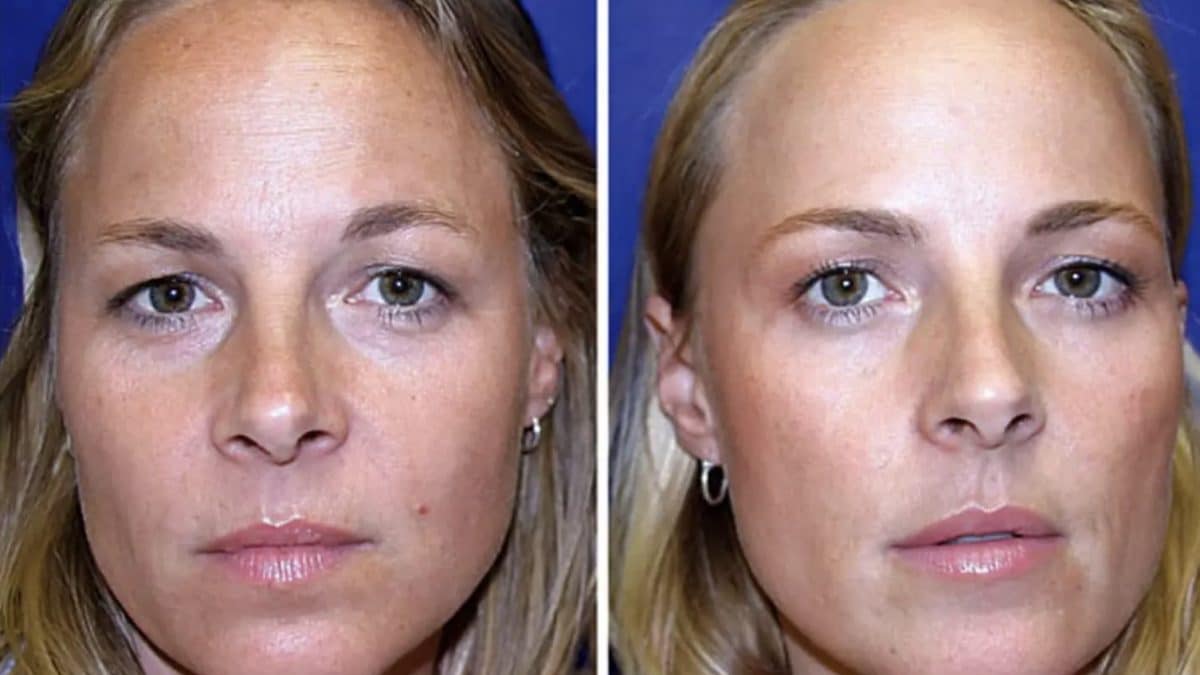 Gêmeas idênticas revelam resultados impressionantes após uma usar botox por 20 anos e a outra não