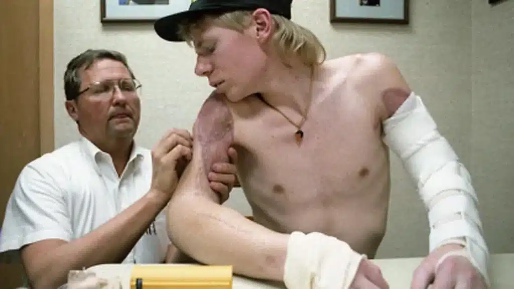 Homem que perdeu os dois braços em um acidente conseguiu reimplantá-los após ligar para a emergência usando um lápis