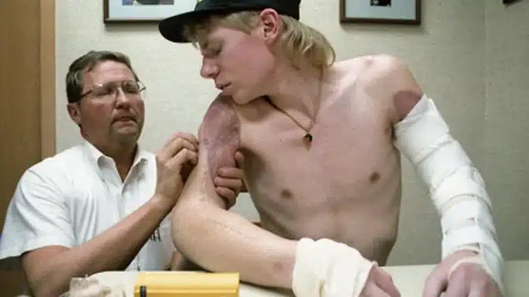 Homem que perdeu os dois braços em um acidente conseguiu reimplantá-los após ligar para a emergência usando um lápis