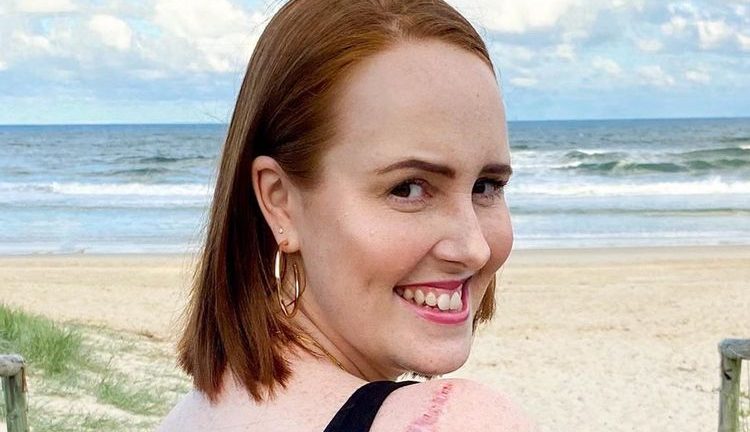 Mulher diagnosticada com câncer de pele em estágio 4 faz alerta sobre sintomas que ela não percebeu até que fosse tarde demais