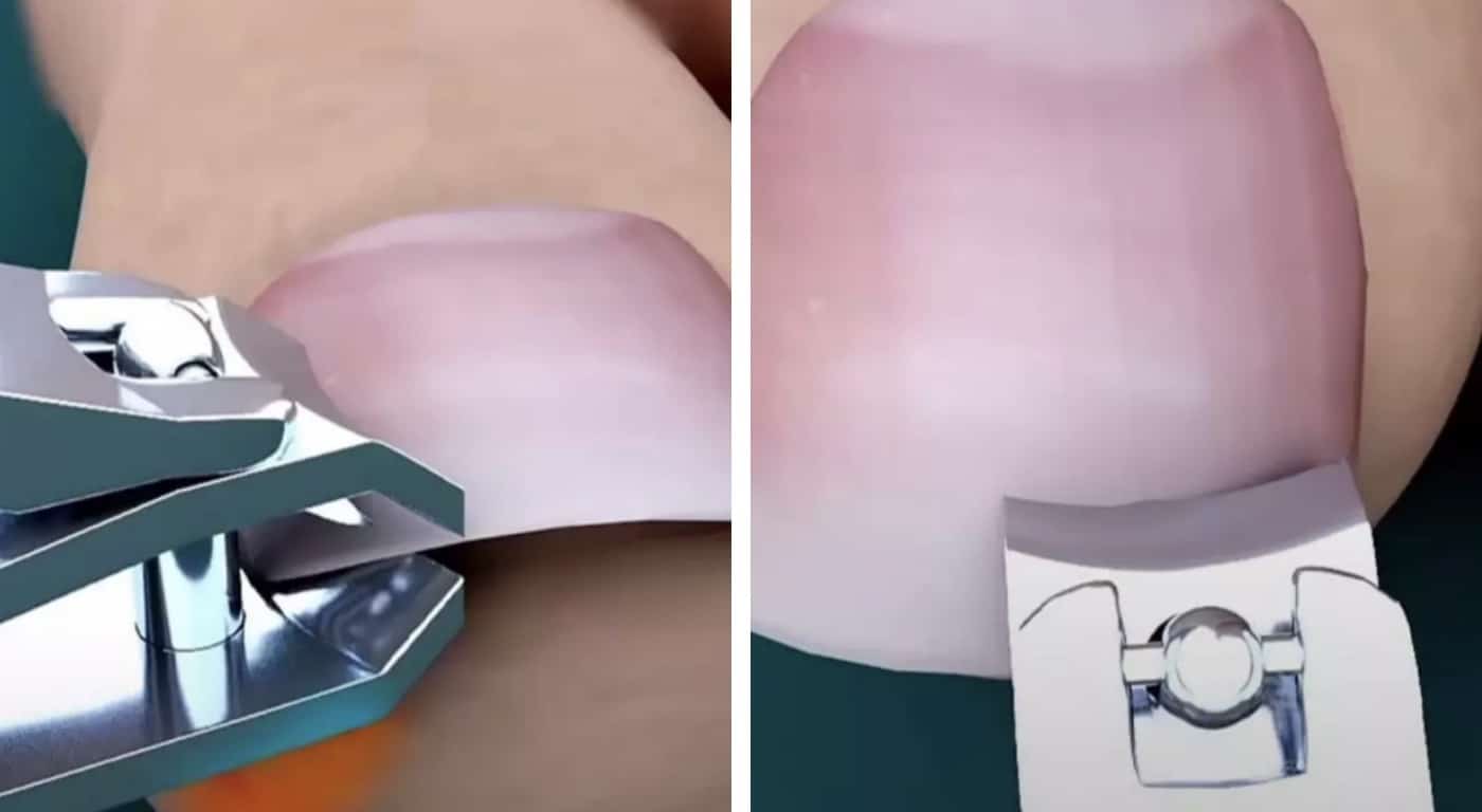 As pessoas estão descobrindo que estão cortando as unhas dos pés de forma errada após verem uma simulação bizarra