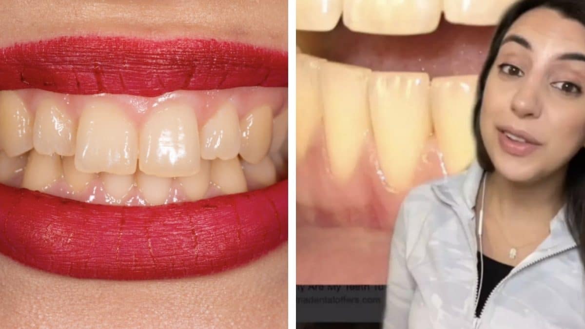 Dentista explica por que seus dentes ficam amarelos mesmo que você "escove sempre"