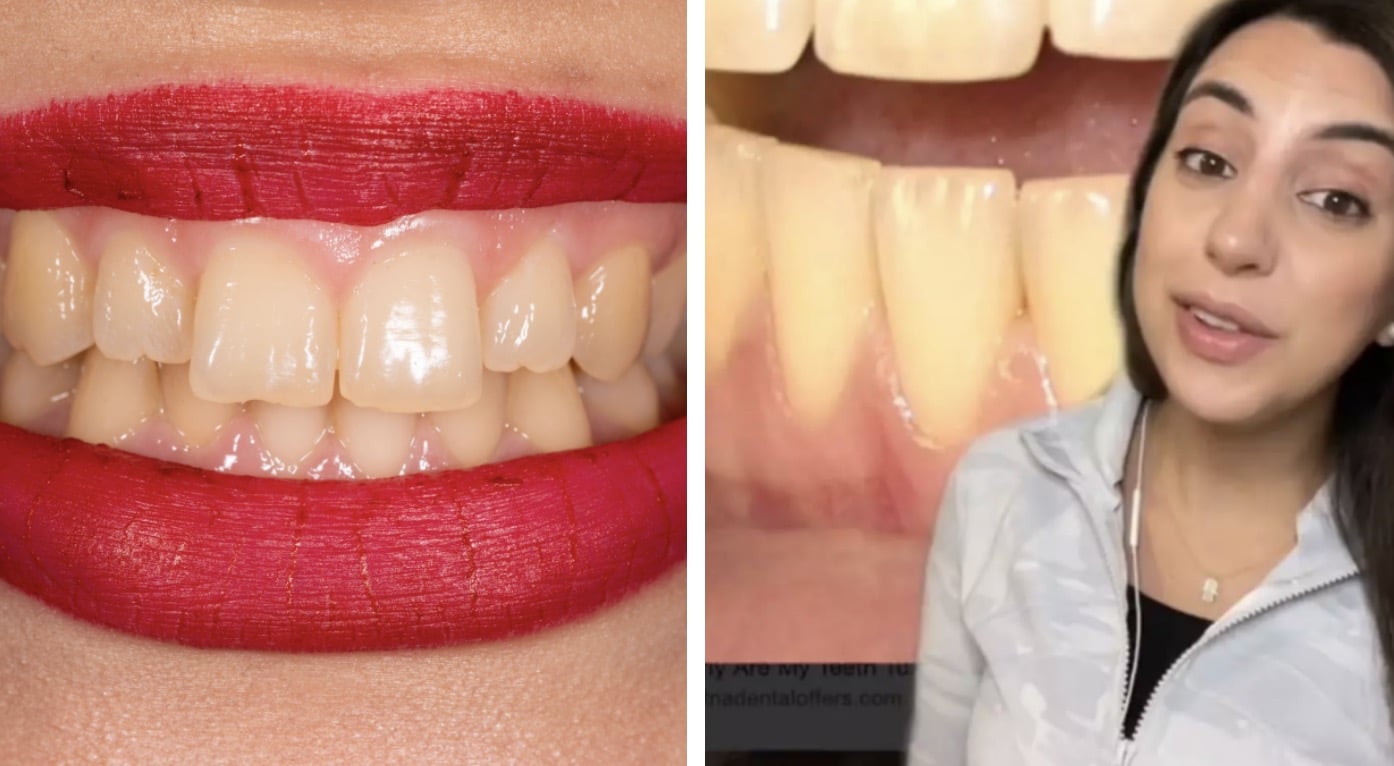 Dentista explica por que seus dentes ficam amarelos mesmo que você "escove sempre"