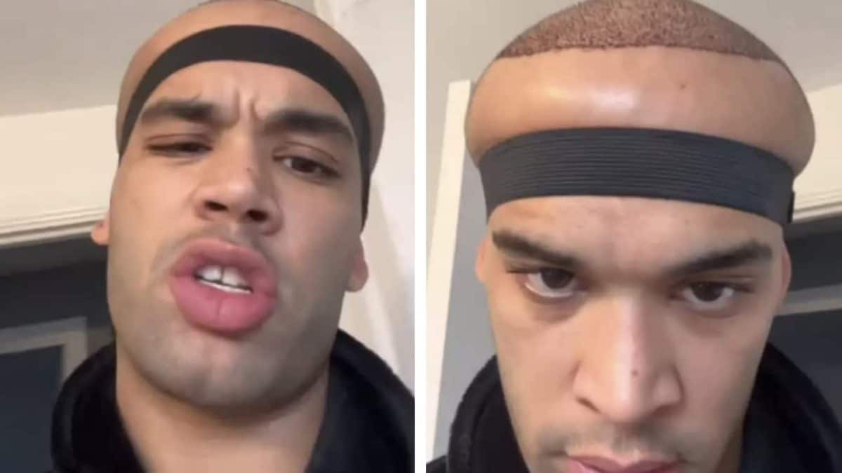 Homem que fez transplante capilar em clínica de celebridades revela resultados e é comparado ao "Megamente" por internautas