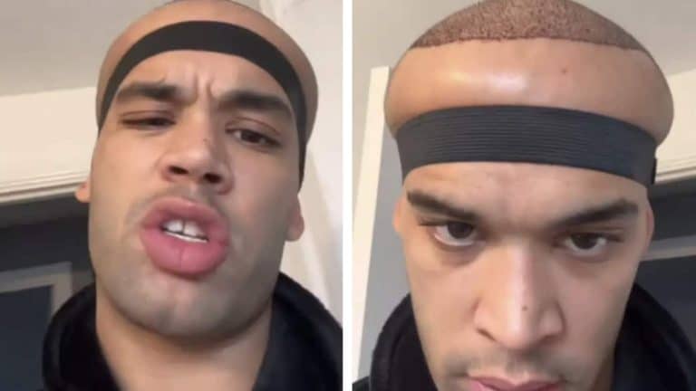 Homem que fez transplante capilar em clínica de celebridades revela resultados e é comparado ao "Megamente" por internautas
