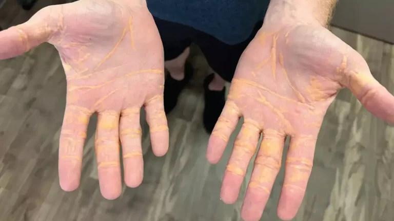 Homem que só comeu "dieta carnívora" por 8 meses revela o impacto que isso teve em sua saúde