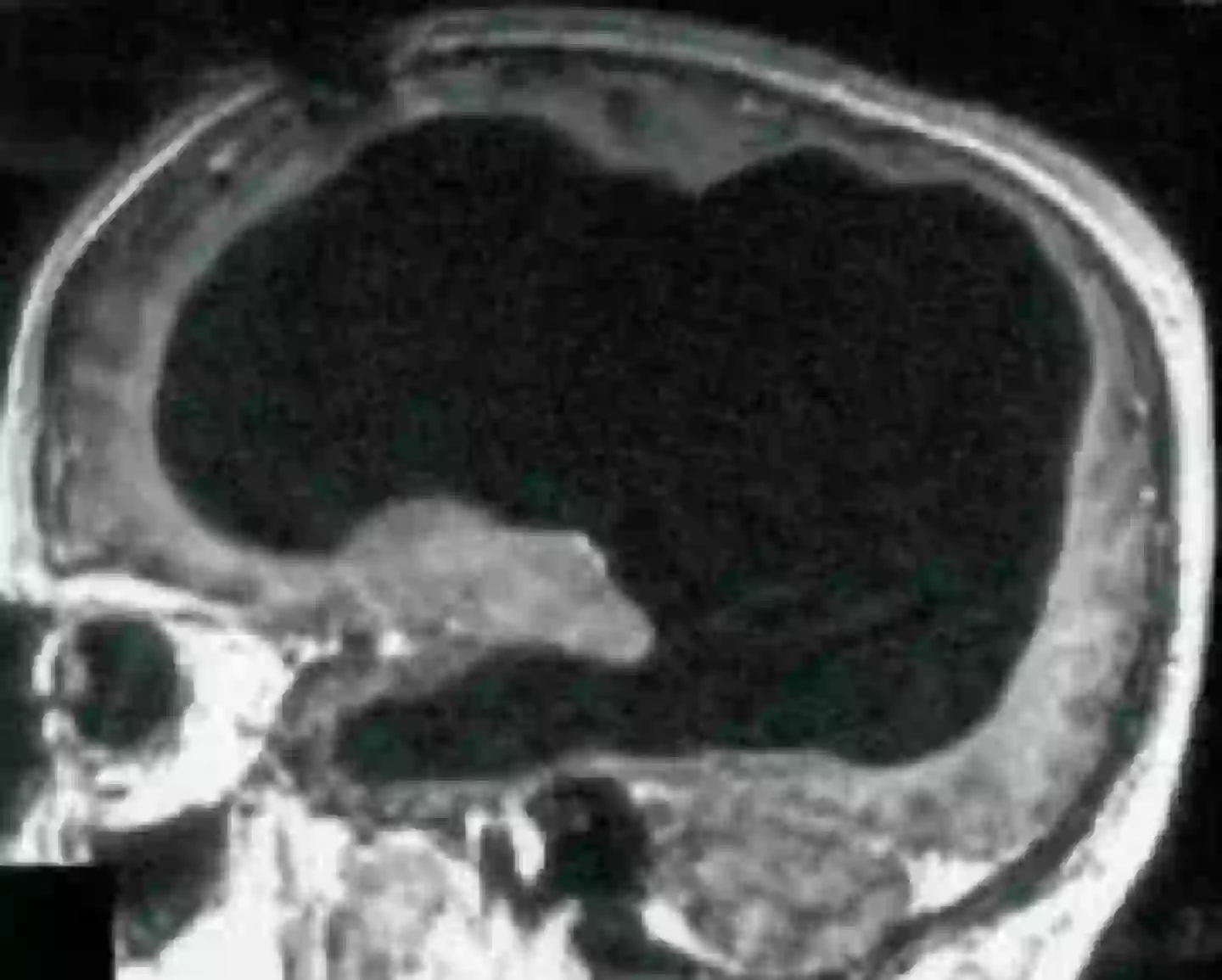 A imagem do exame deveria mostrar o cérebro do homem... exceto que a maior parte dele está faltando. (Feuillet et al./The Lancet)