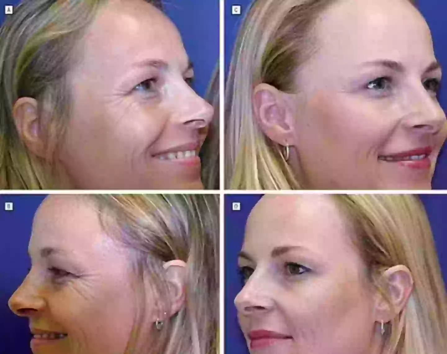 As imagens A e B mostram os resultados da gêmea que não usou Botox, enquanto as imagens C e D revelam as diferenças da gêmea que fez o tratamento com Botox (American Medical Association).