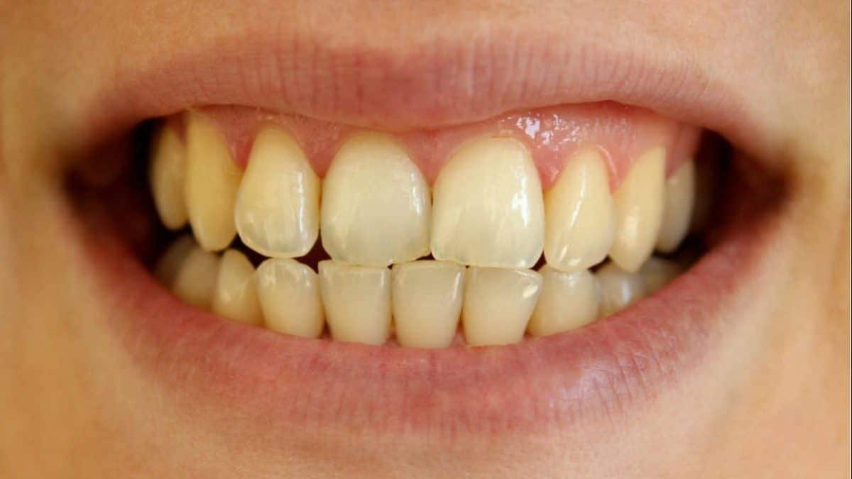 Dentista revela os 7 principais motivos pelos quais seus dentes ficam amarelos e como você pode evitar que isso aconteça