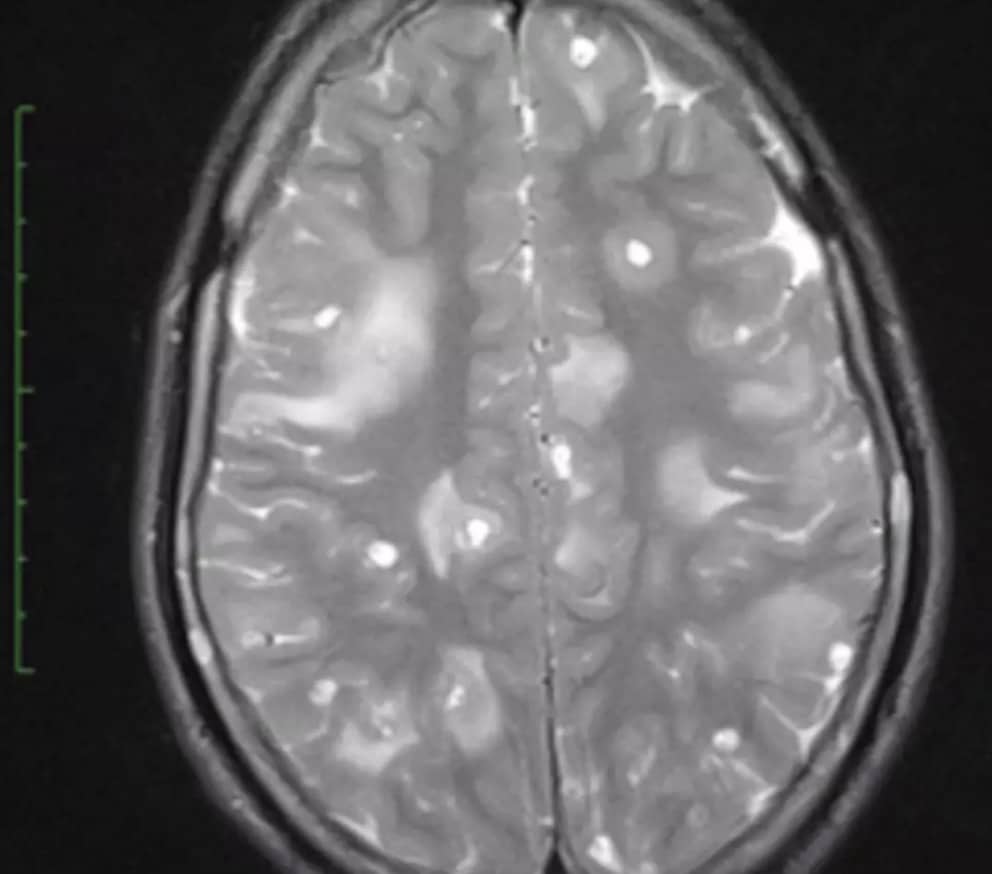 Menina de 10 anos contrai parasita 'do tamanho de um arroz' após comer carne malcozida em uma das 'tomografias mais impressionantes já vistas' A tomografia computadorizada do seu cérebro (RSNA)