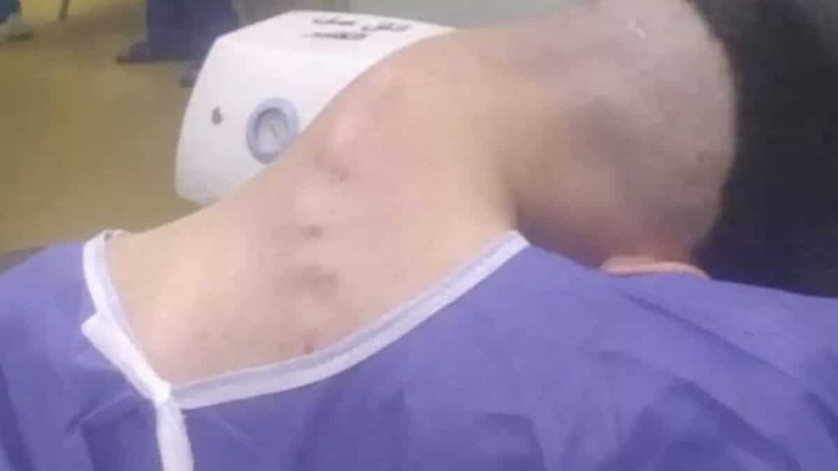 Homem de 23 anos desenvolve rara condição chamada ‘síndrome da cabeça caída’ após anos lutando contra vício