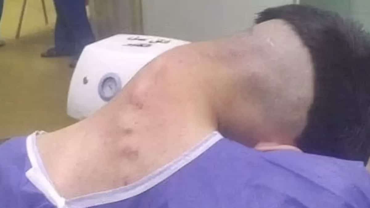 Homem sofre de rara síndrome da cabeça caída causada por vício