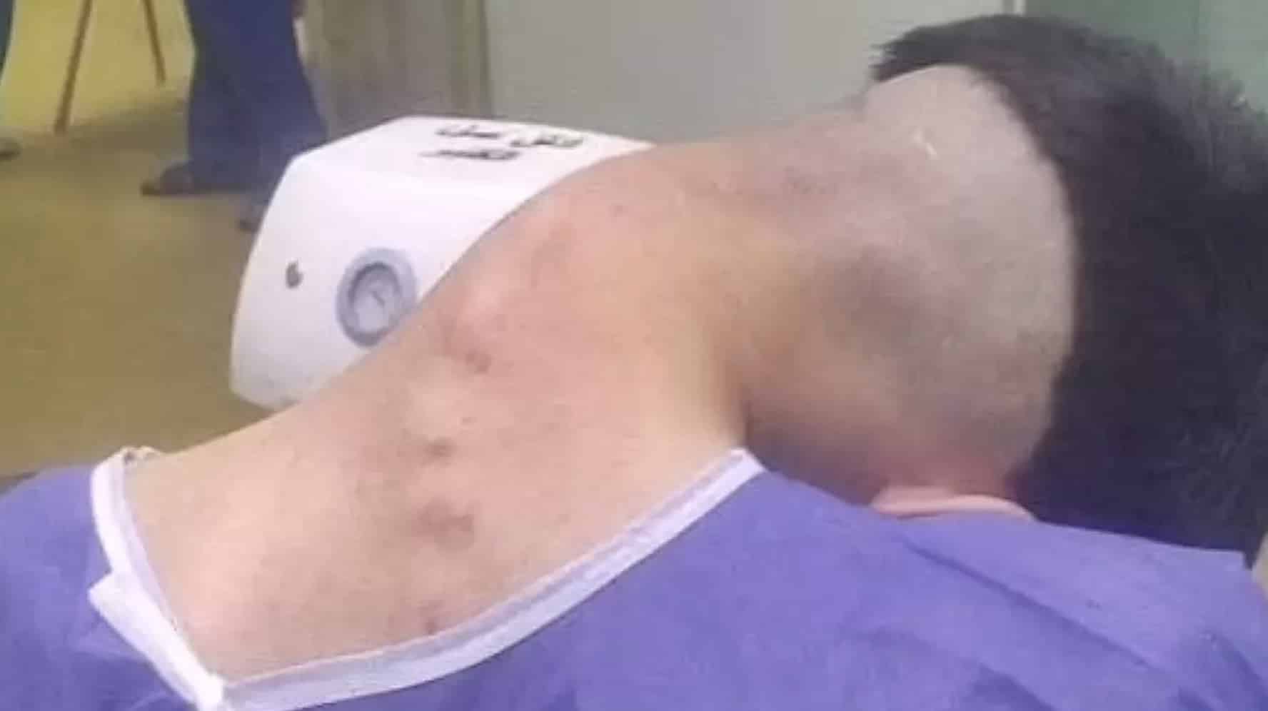 Homem sofre de rara síndrome da cabeça caída causada por vício Homem sofre de rara síndrome da cabeça caída causada por vício