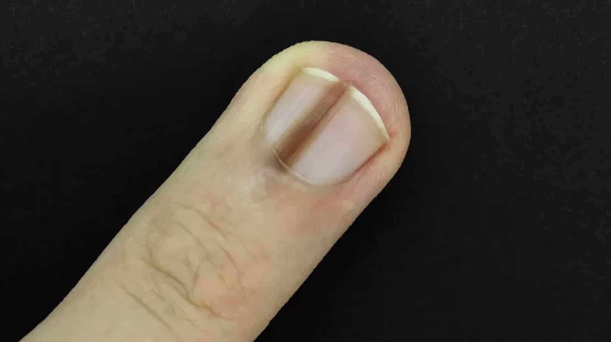 Pessoas alertam homem para verificar seu dedo com um médico imediatamente após ele postar foto preocupante Pessoas alertam homem para verificar seu dedo com um médico imediatamente após ele postar foto preocupante